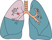 Clipart of Anterior view of lungs suffering from atelectasis caused by ...