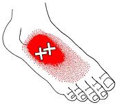 Stock Illustration of Flexor digitorum brevis m., trigger points ...