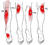 Stock Illustration of Triceps brachii m., trigger points mm115006 ...